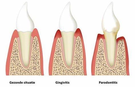 Gingivitis parodontitis Parodontologie Mondhygienist Amersfoort