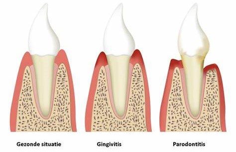 Parodontologie Mondhygienist Amersfoort